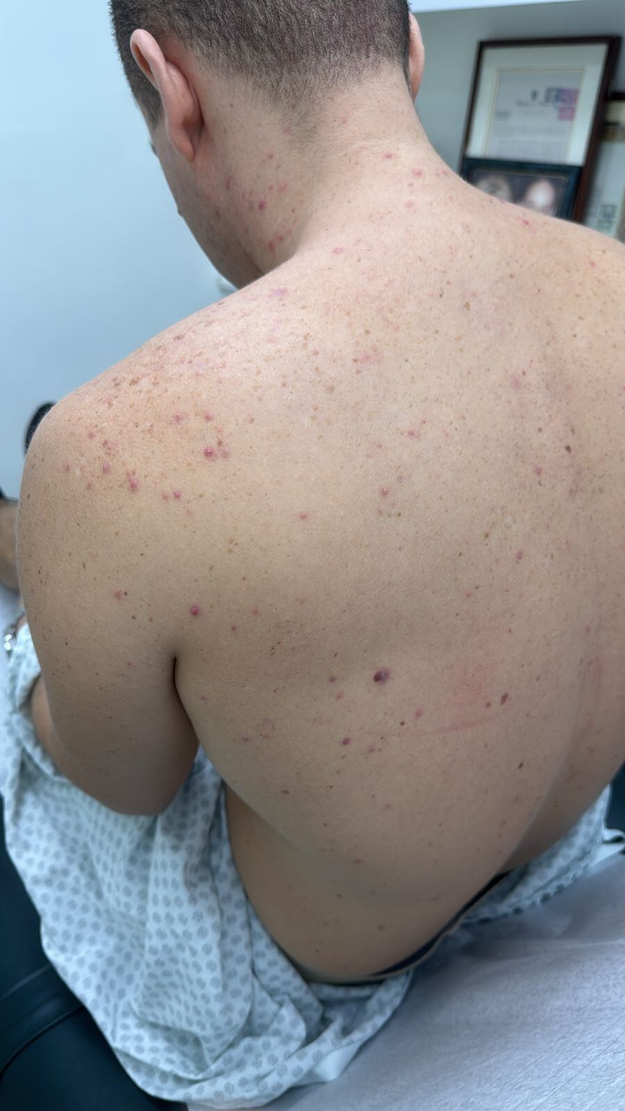 Antes - Caso clínico: Acné por corticoides y complejo B