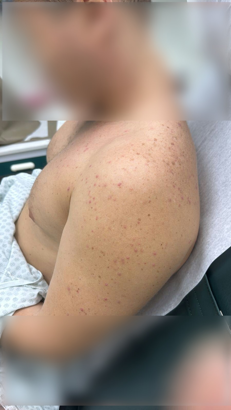 Caso clínico: Acné por corticoides y complejo B