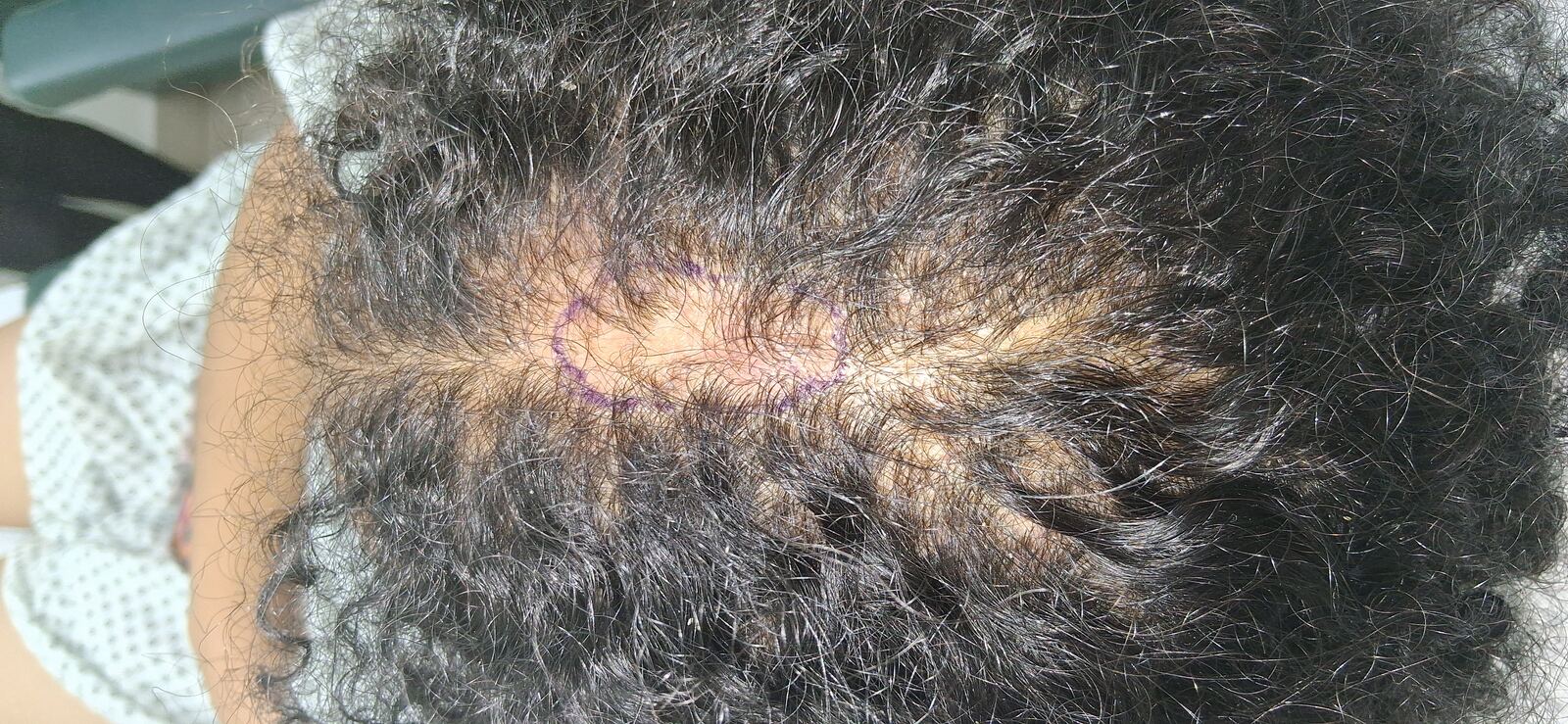 Caso clínico: Adenopatía