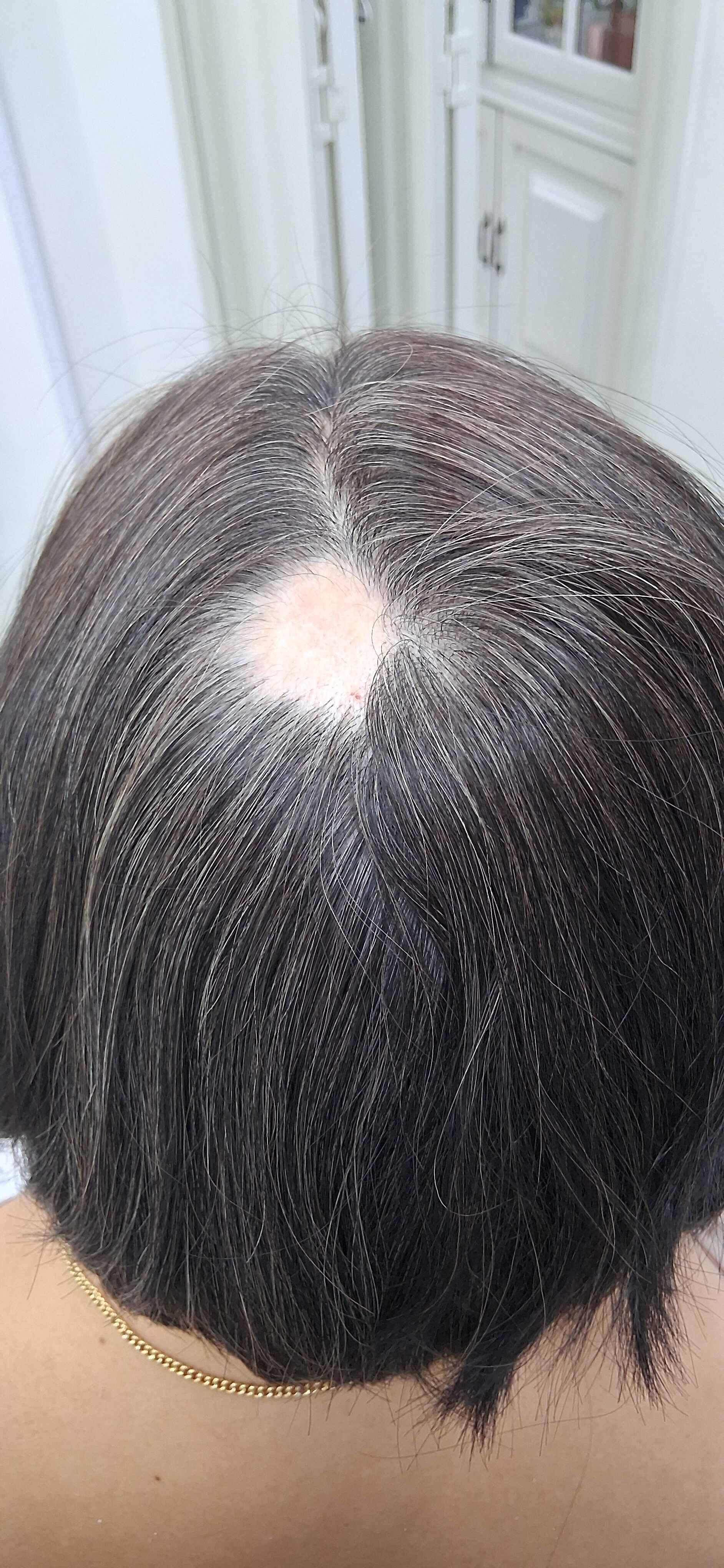 Después - Caso clínico: Alopecia areata