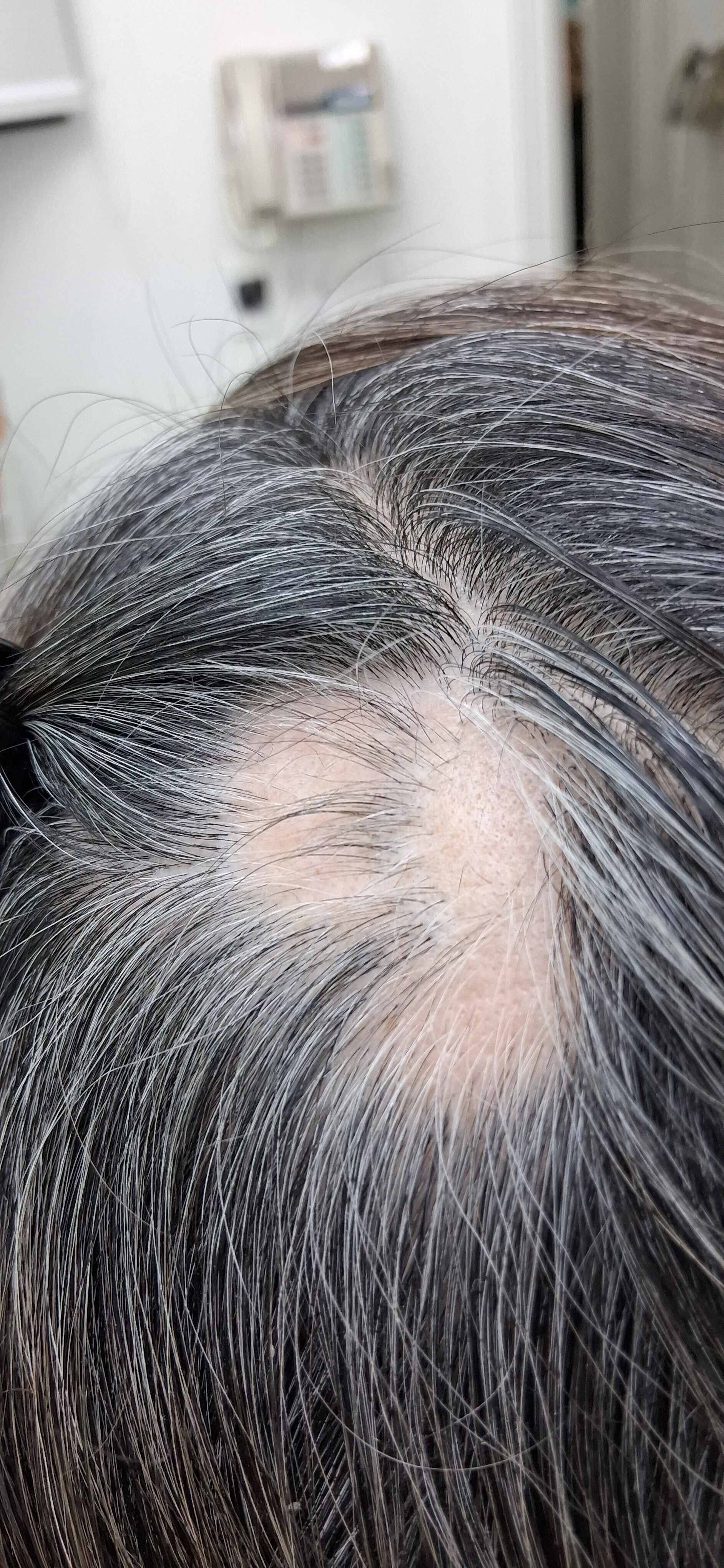 Caso clínico: Alopecia areata