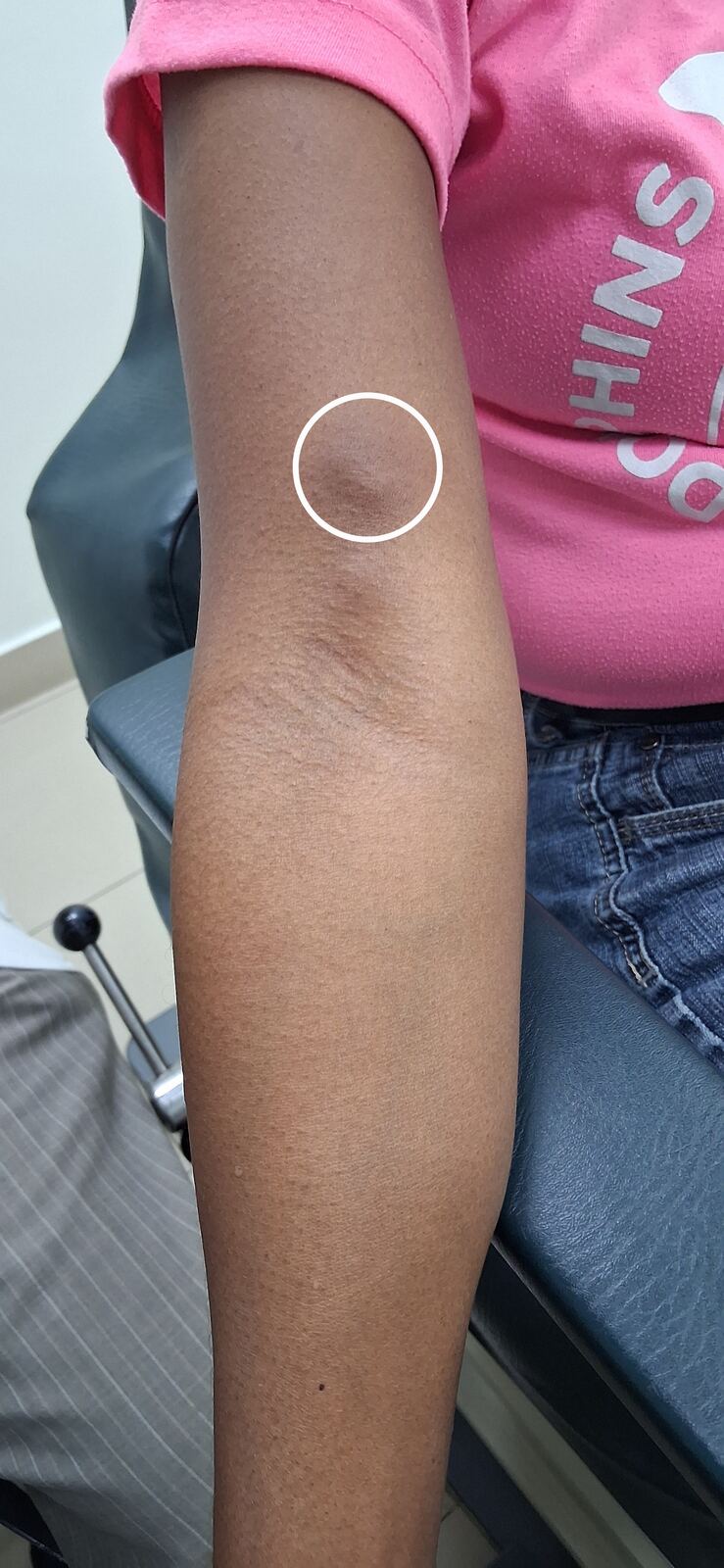 Antes - Caso clínico: Calcinosis cutis, polimiositis y dermatomiositis