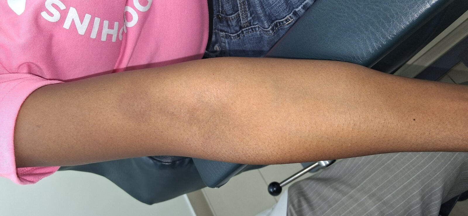 Caso clínico: Calcinosis cutis, polimiositis y dermatomiositis