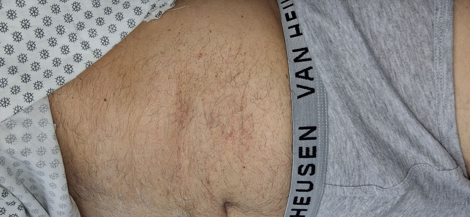 Antes - Caso clínico: Capilaritis abdominal y xerosis