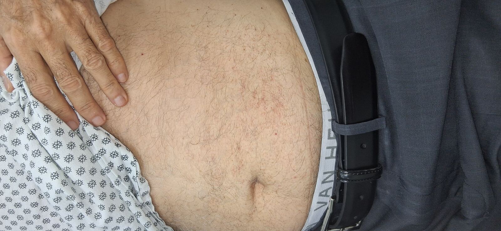 Después - Caso clínico: Capilaritis abdominal y xerosis