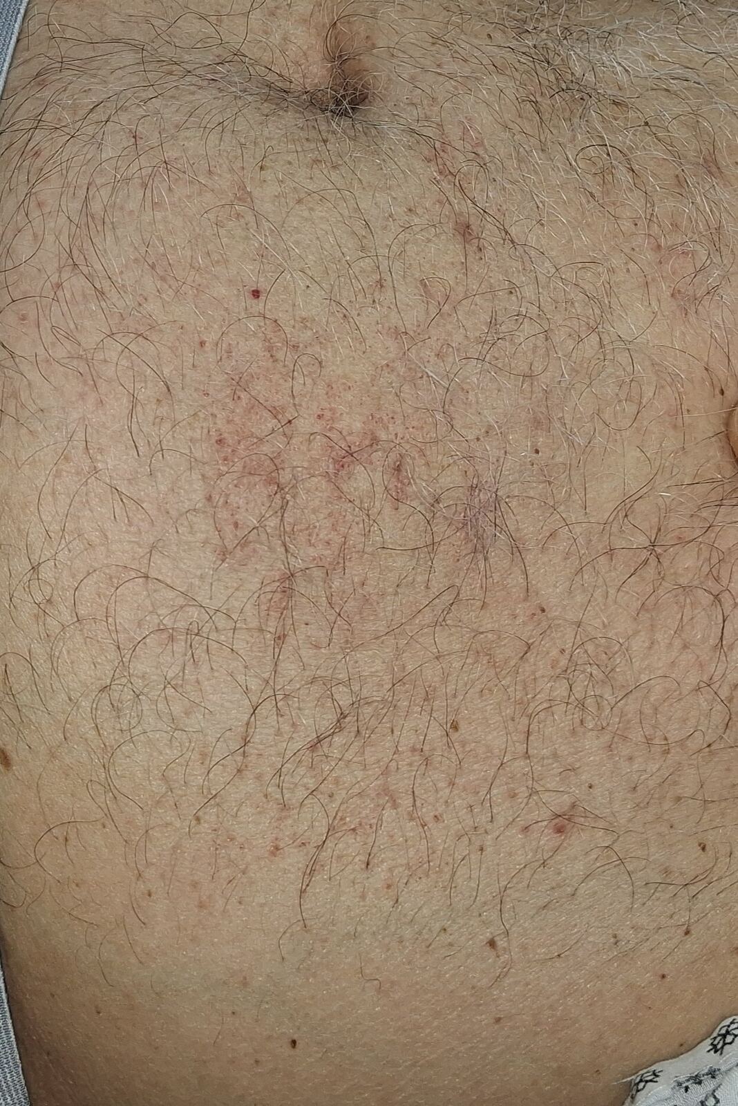 Caso clínico: Capilaritis abdominal y xerosis