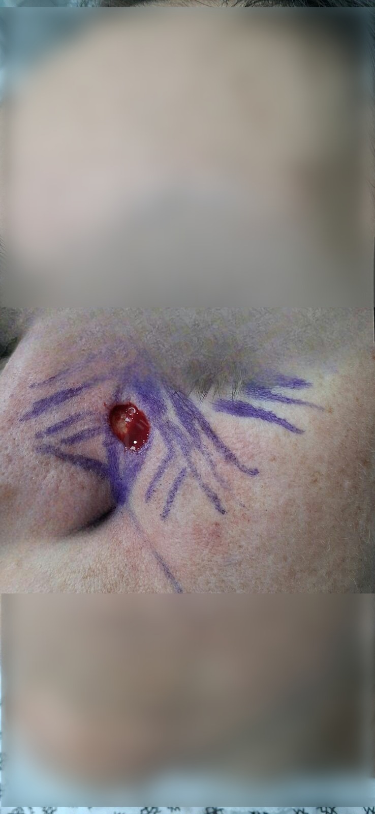 Antes - Caso clínico: Carcinoma basocelular
