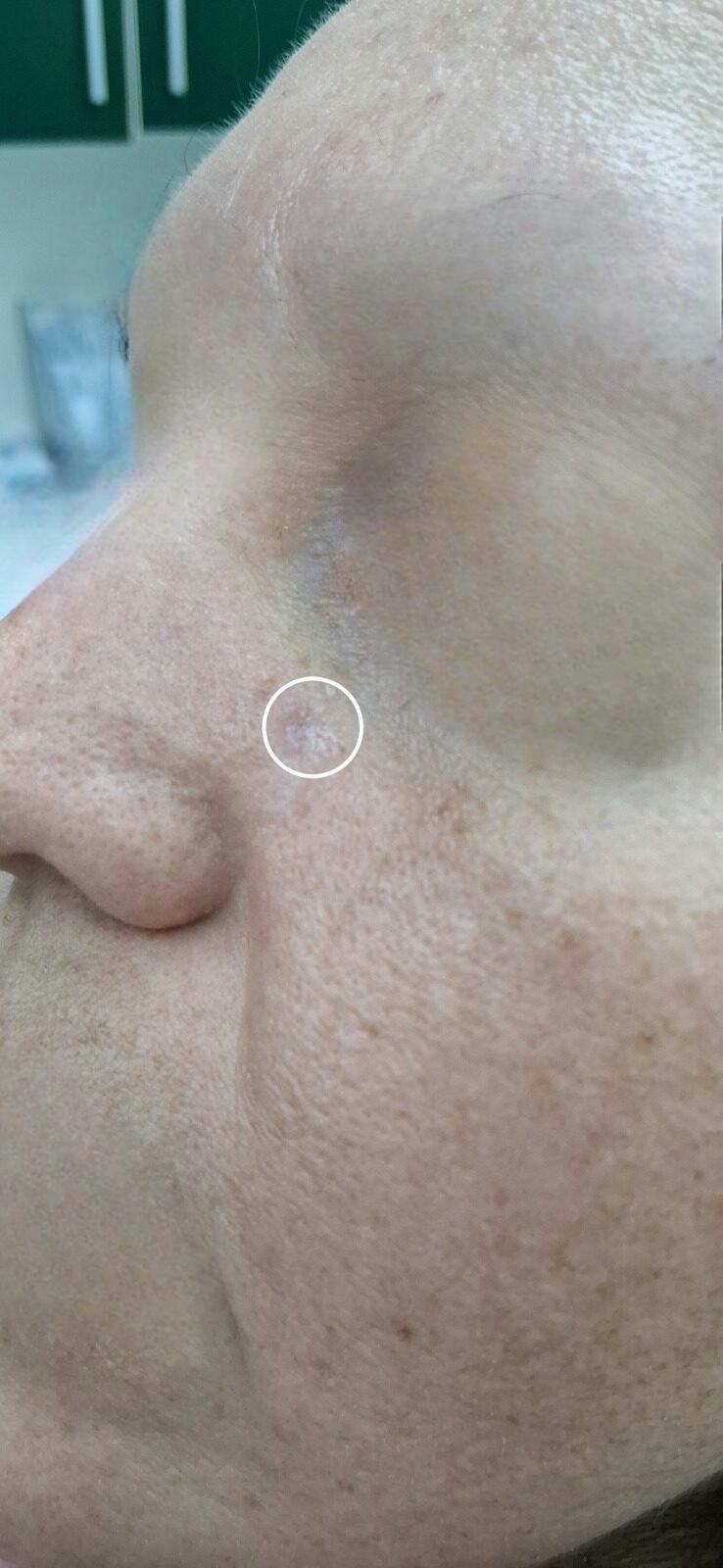 Después - Caso clínico: Carcinoma basocelular