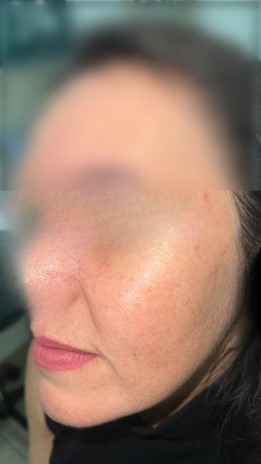 Caso clínico: Carcinoma basocelular