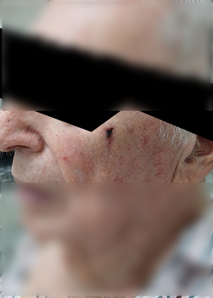 Antes - Caso clínico: Carcinoma escamoso