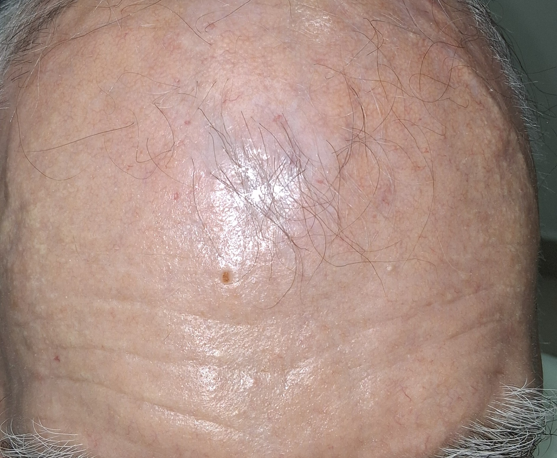 Después - Caso clínico: Carcinoma escamoso