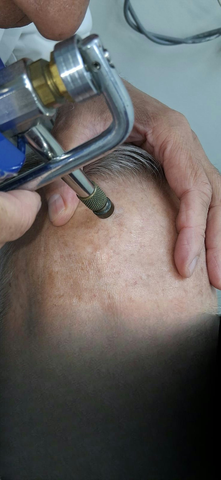 Antes - Caso clínico: Carcinoma escamoso in situ