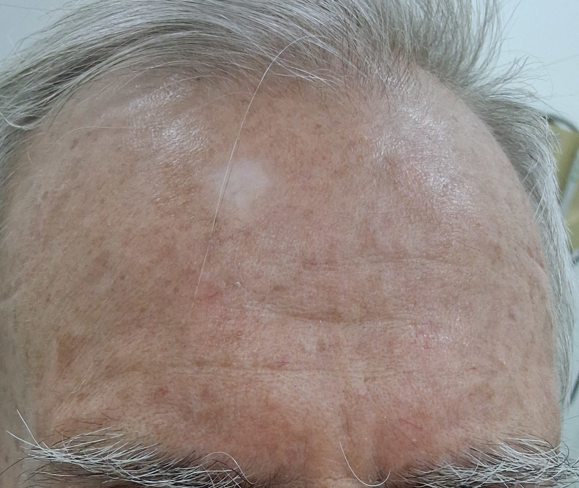 Después - Caso clínico: Carcinoma escamoso in situ