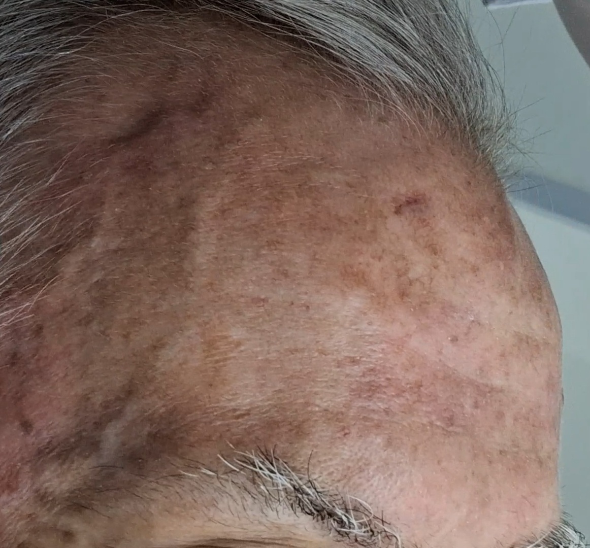 Caso clínico: Carcinoma escamoso in situ