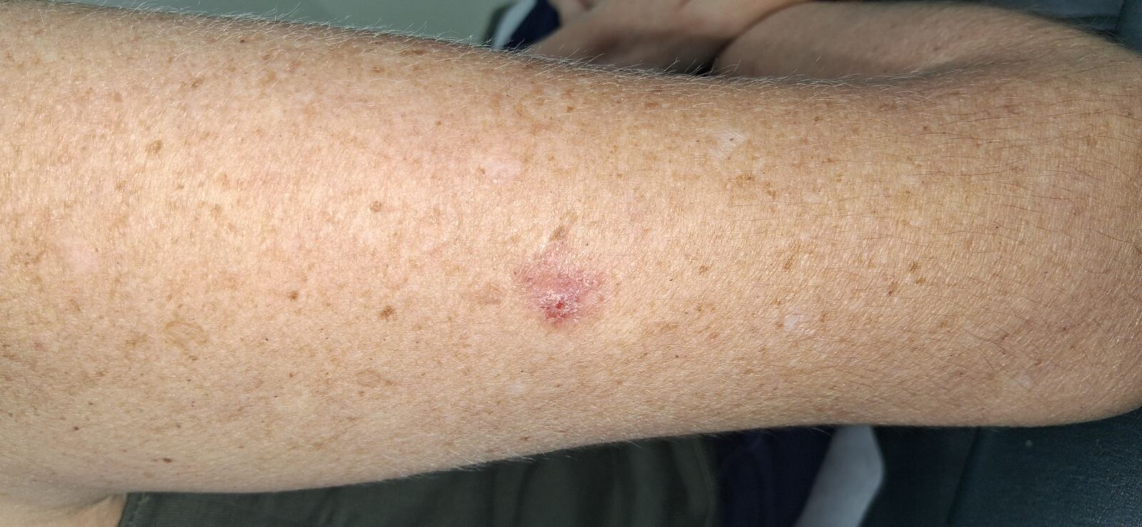 Caso clínico: Carcinoma escamoso vs carcinoma basocelular
