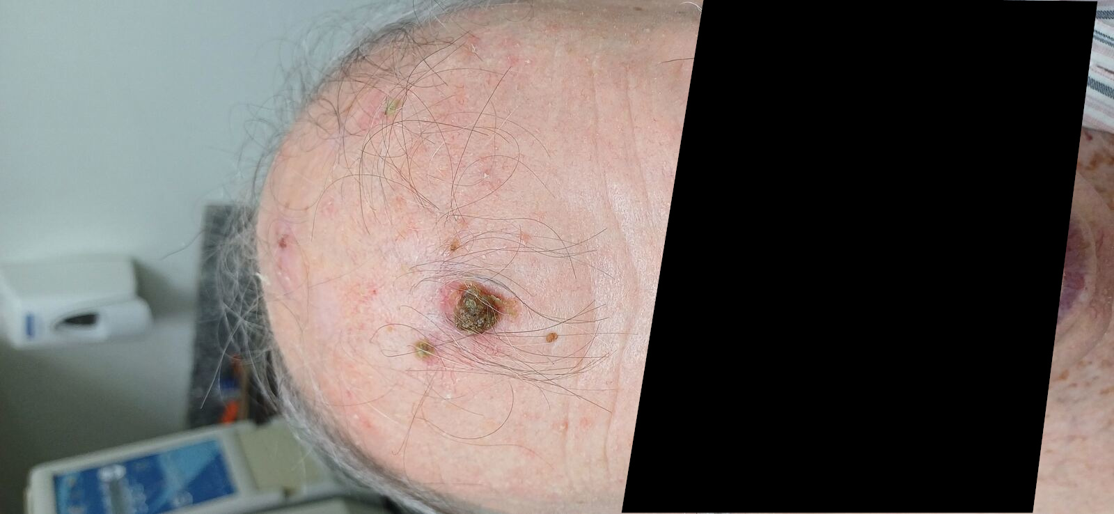 Caso clínico: Carcinoma escamoso