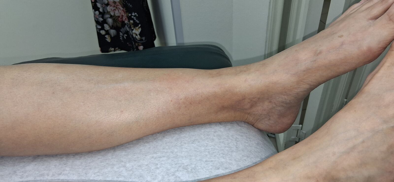 Antes - Caso clínico: Celulitis