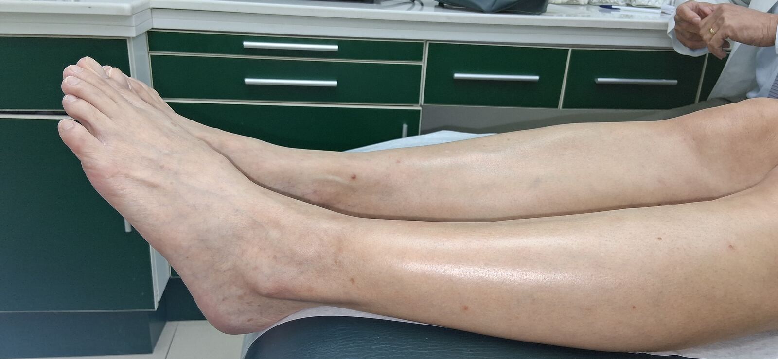 Después - Caso clínico: Celulitis