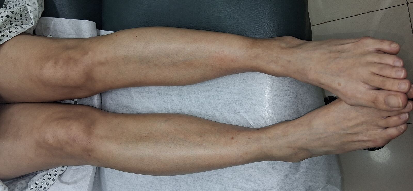 Caso clínico: Celulitis