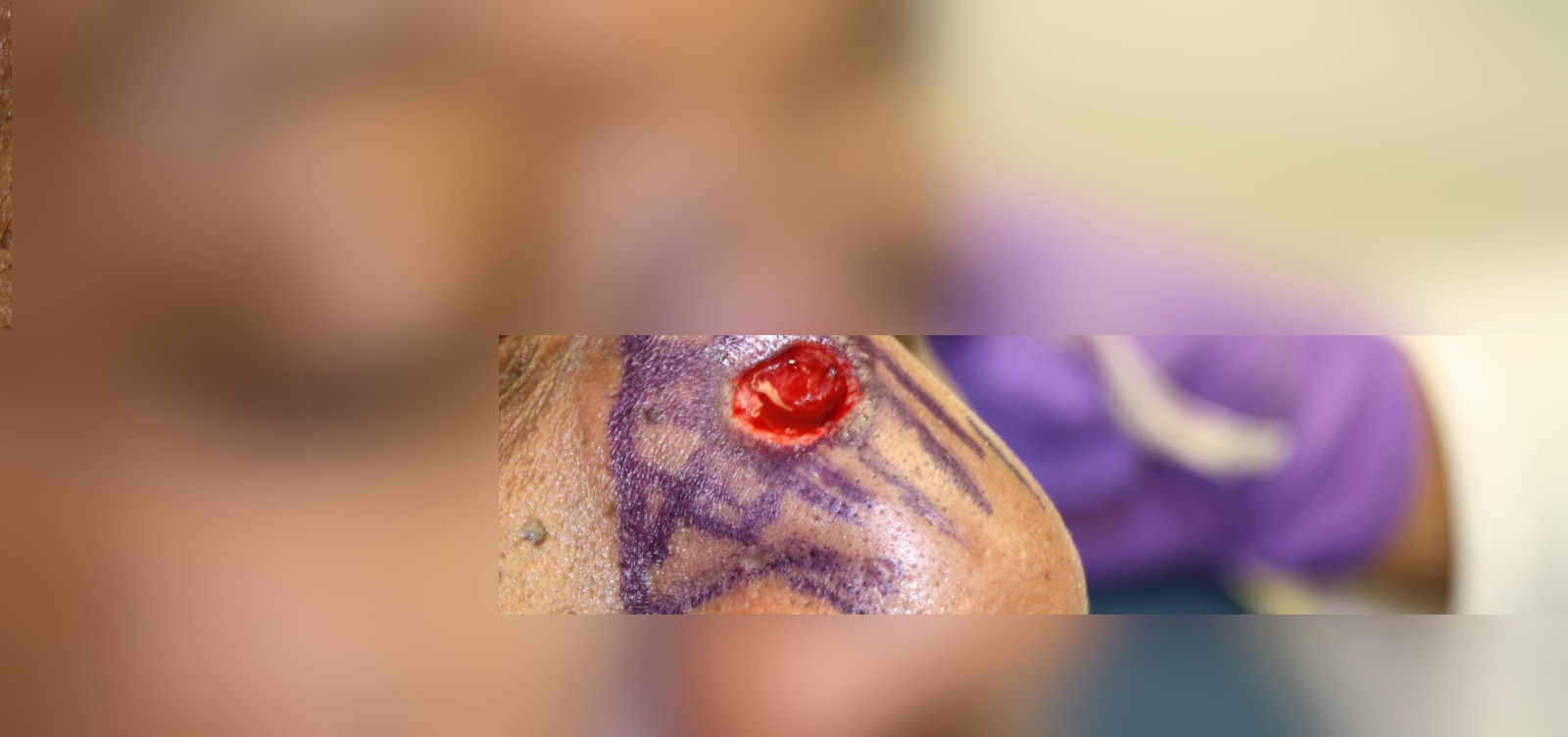 Antes - Caso clínico: Cirugía de Mohs con control microscópico