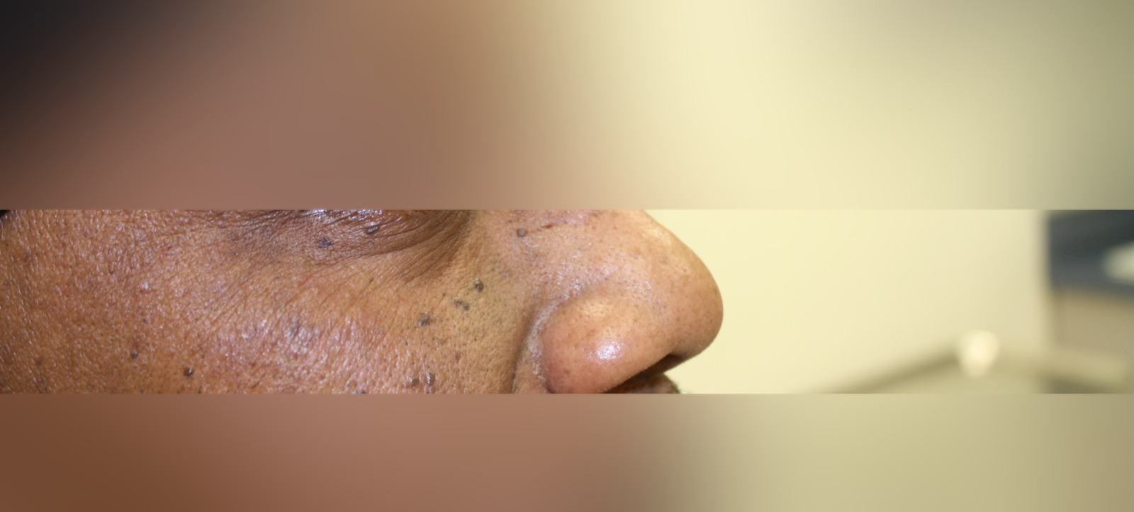Después - Caso clínico: Cirugía de Mohs con control microscópico