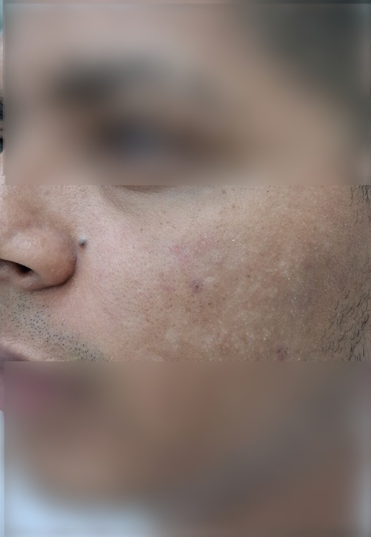 Antes - Caso clínico: Demodex