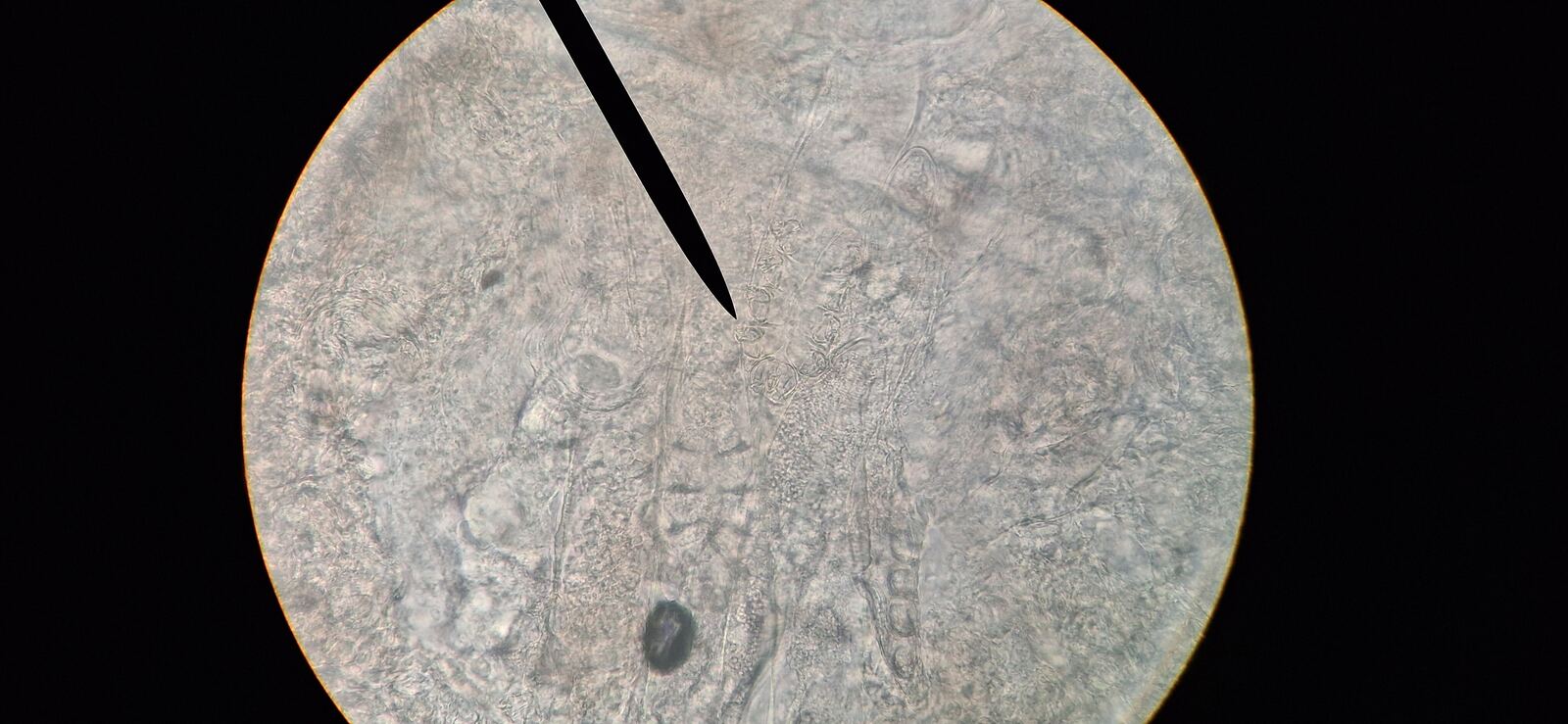 Antes - Caso clínico: Demodex y dermatitis seborreica