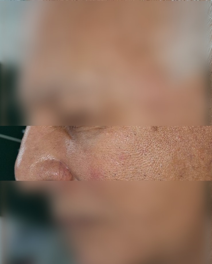 Después - Caso clínico: Demodex y dermatitis seborreica