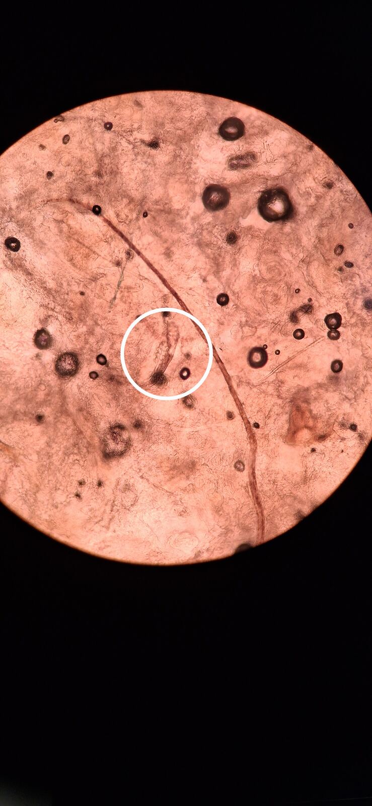 Antes - Caso clínico: Demodex y rinofima