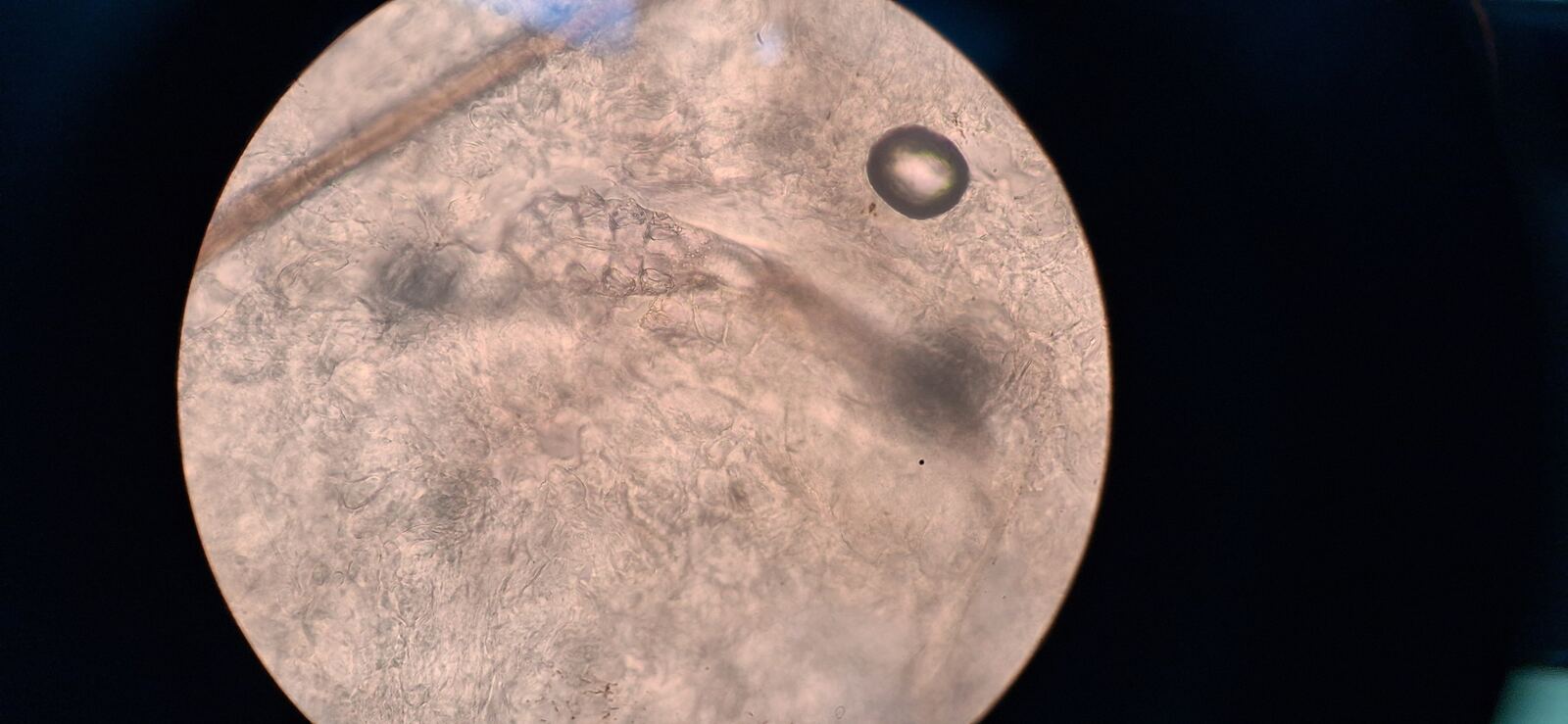 Después - Caso clínico: Demodex y rinofima