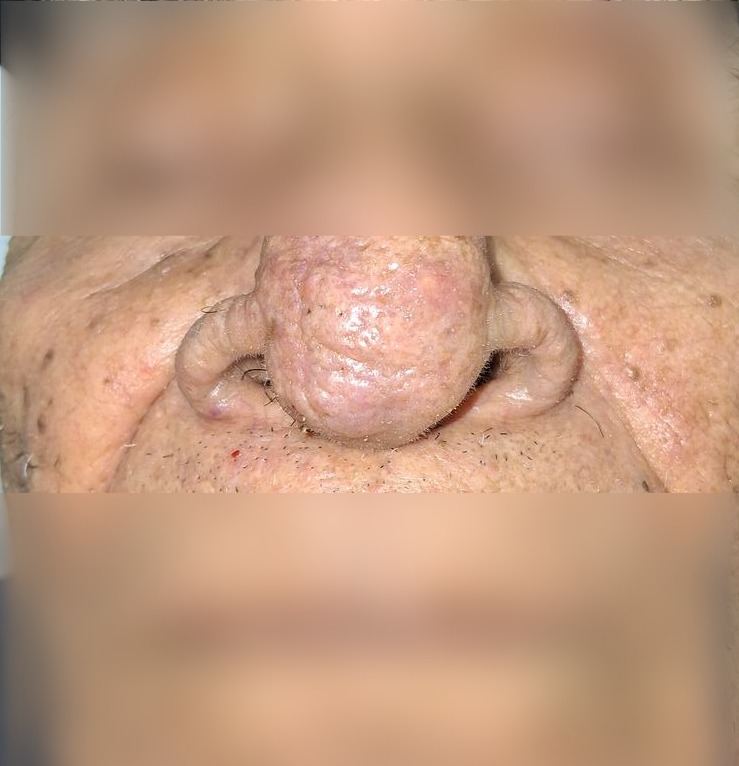 Caso clínico: Demodex y rinofima
