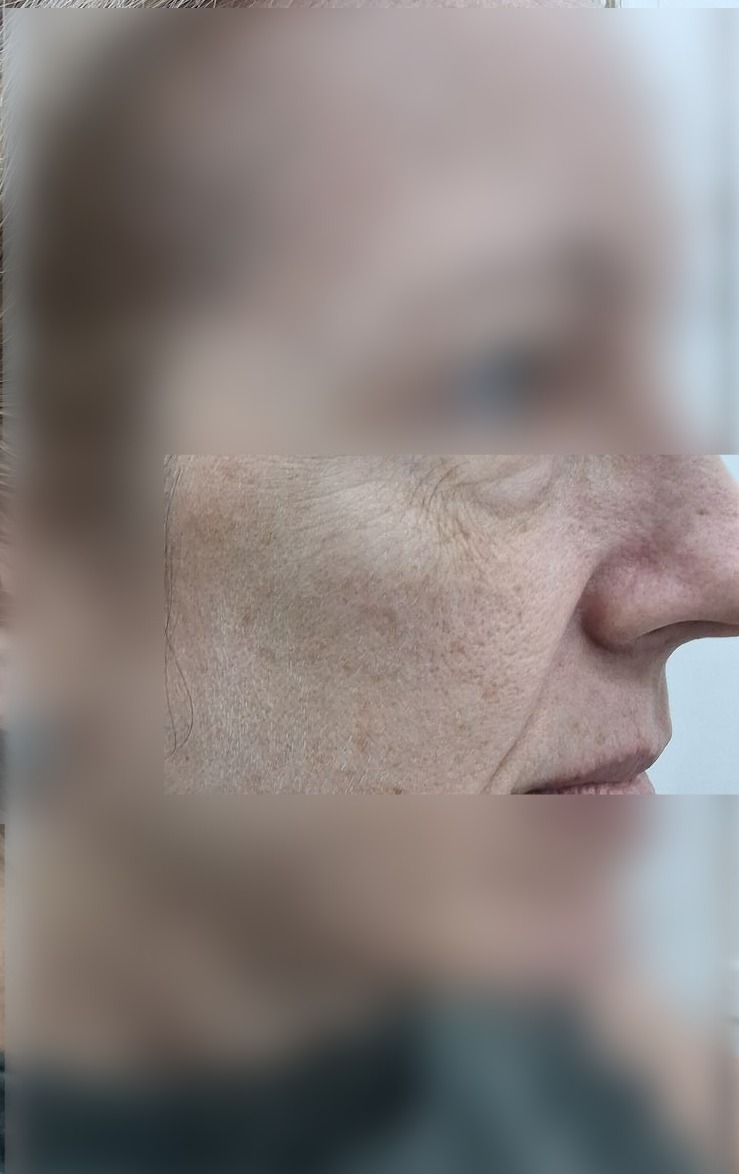 Antes - Caso clínico: Demodex y rosácea