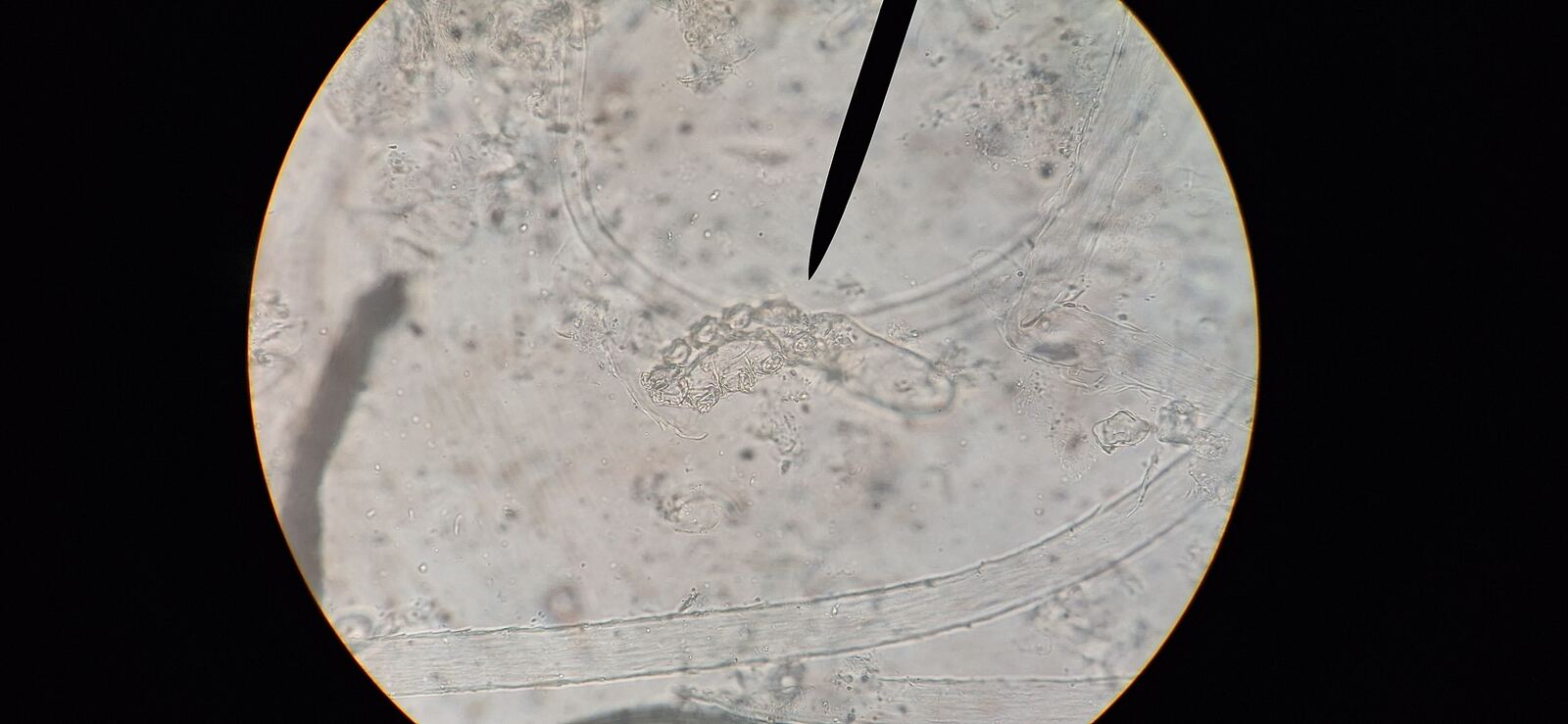 Después - Caso clínico: Demodex y rosácea