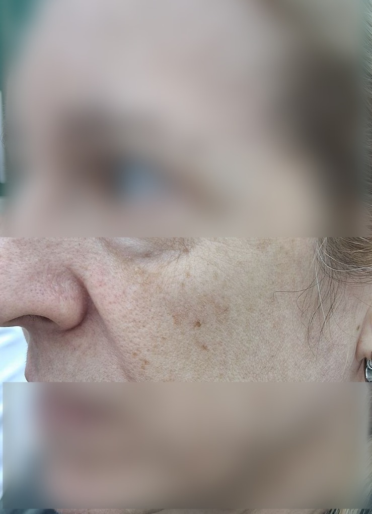 Caso clínico: Demodex y rosácea