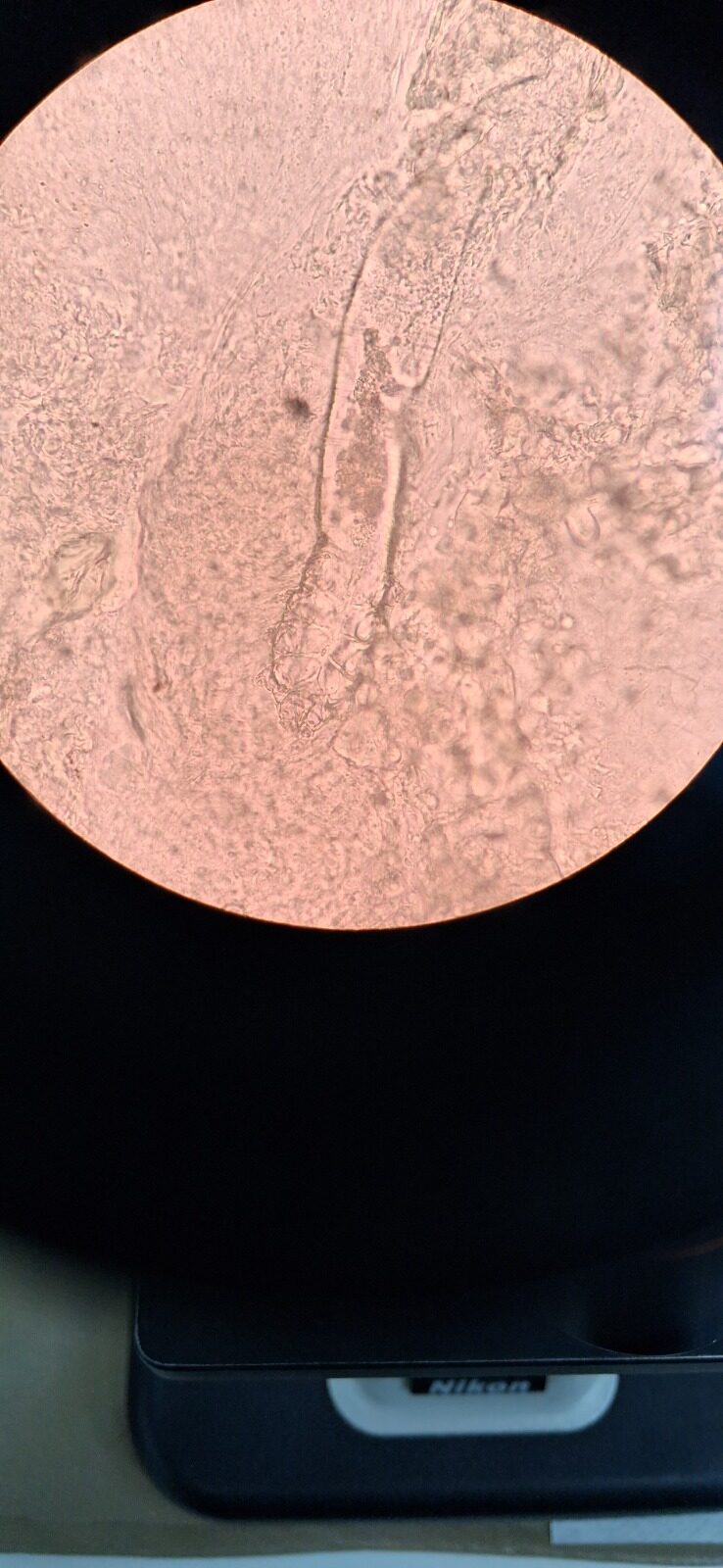 Caso clínico: Demodex