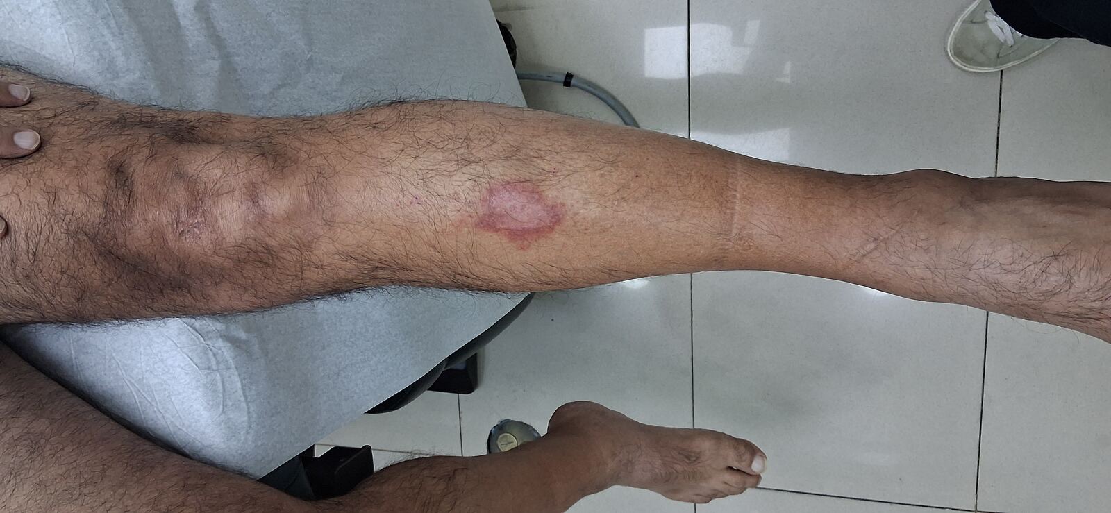 Antes - Caso clínico: Dermatitis