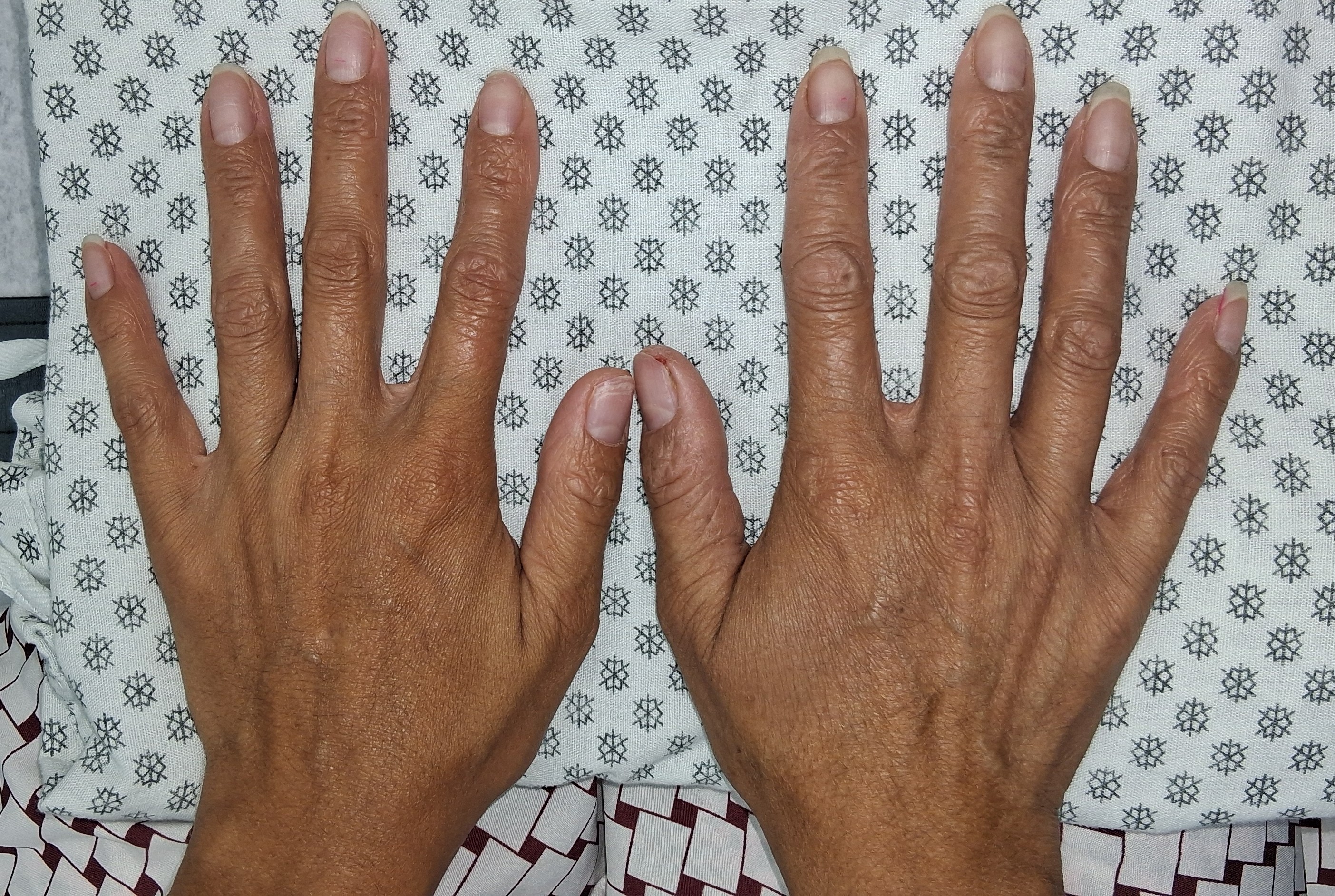 Antes - Caso clínico: Dermatitis atópica