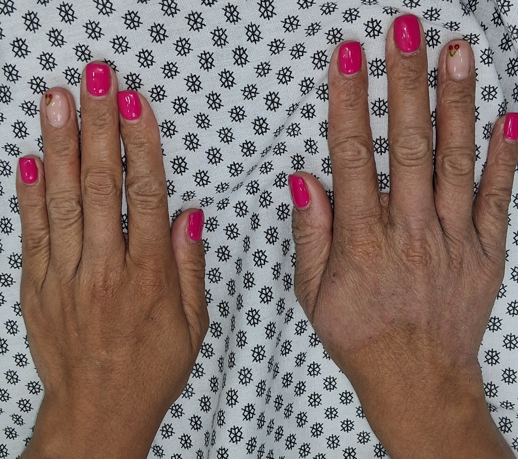 Después - Caso clínico: Dermatitis atópica