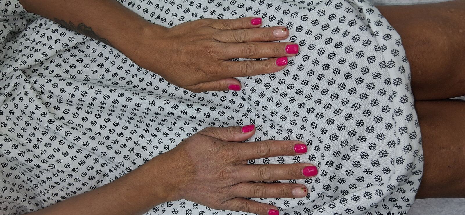 Caso clínico: Dermatitis atópica