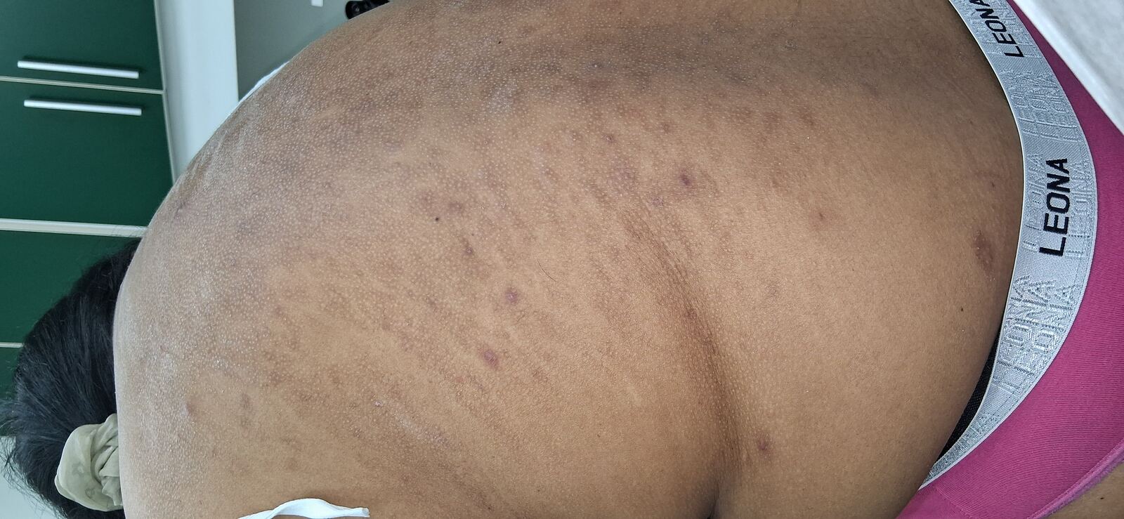 Antes - Caso clínico: Dermatitis infectada