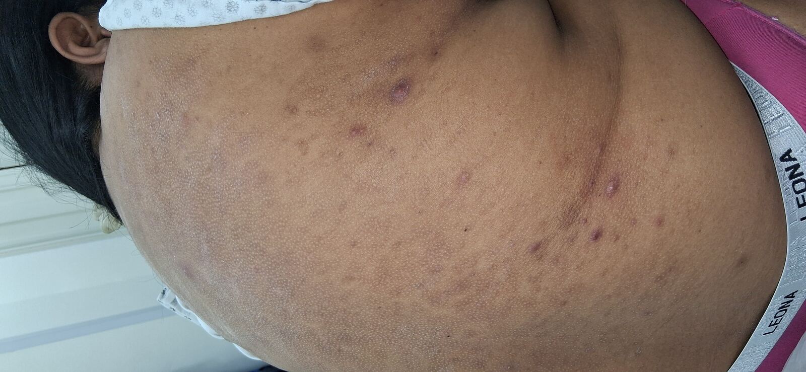 Después - Caso clínico: Dermatitis infectada