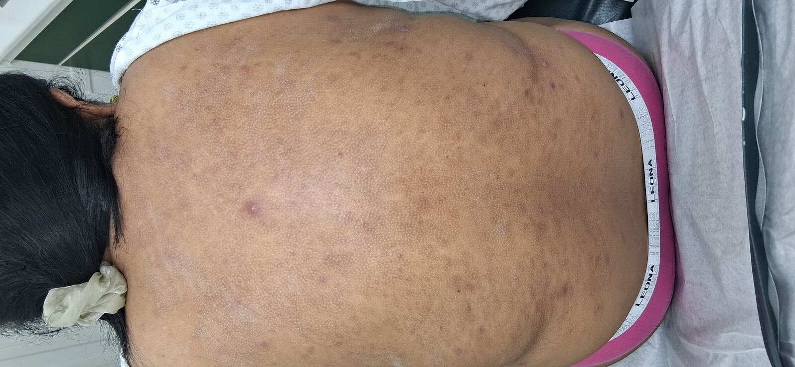 Caso clínico: Dermatitis infectada