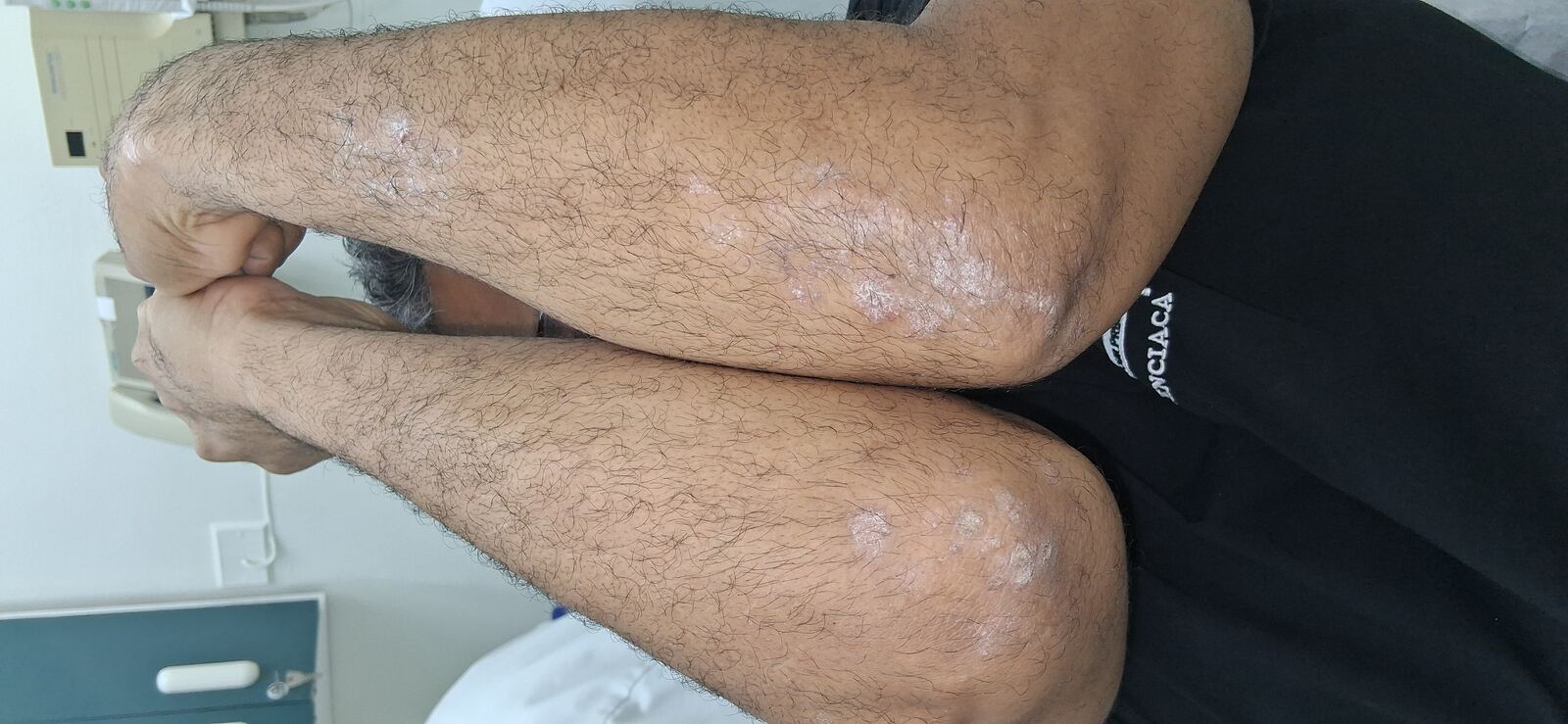 Antes - Caso clínico: Dermatitis liquenoide vs psoriasis