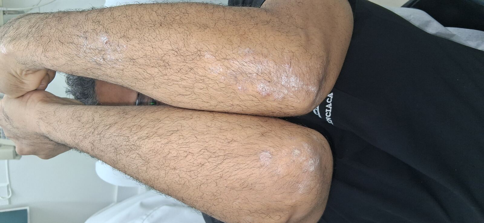 Caso clínico: Dermatitis liquenoide vs psoriasis