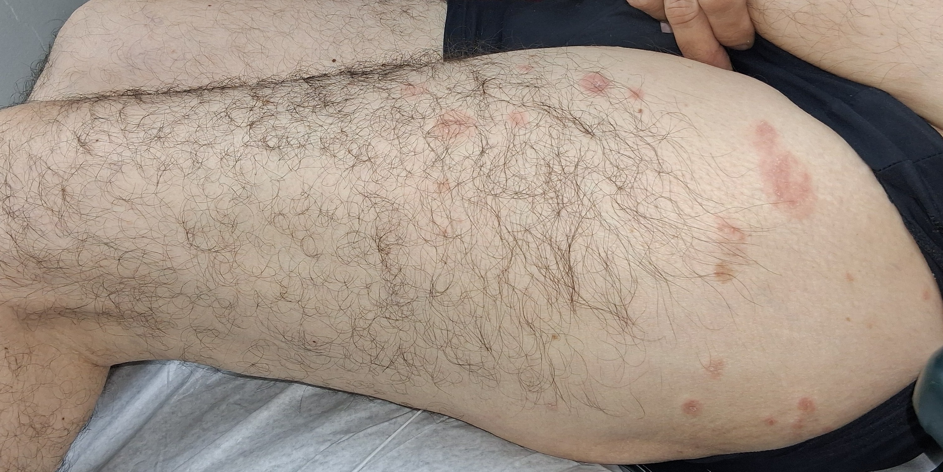 Antes - Caso clínico: Dermatitis numular