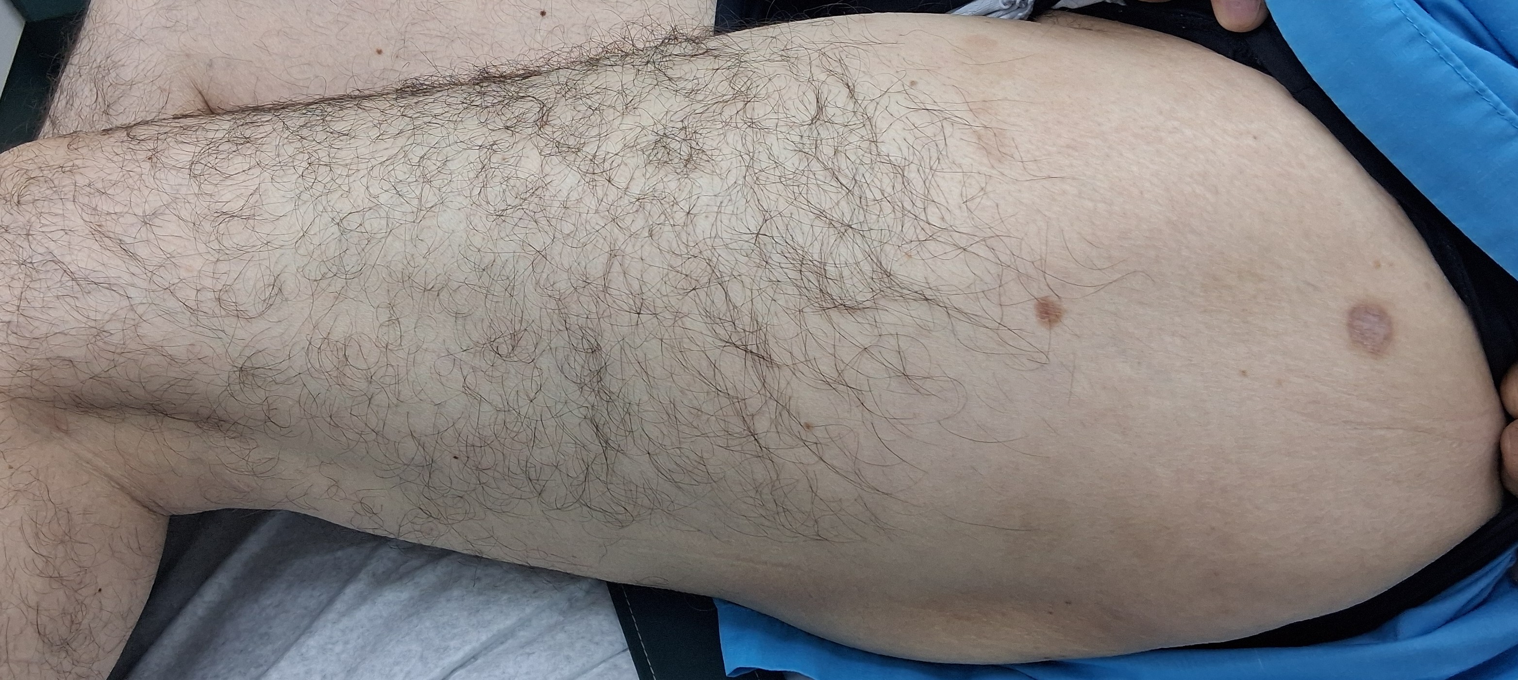 Después - Caso clínico: Dermatitis numular