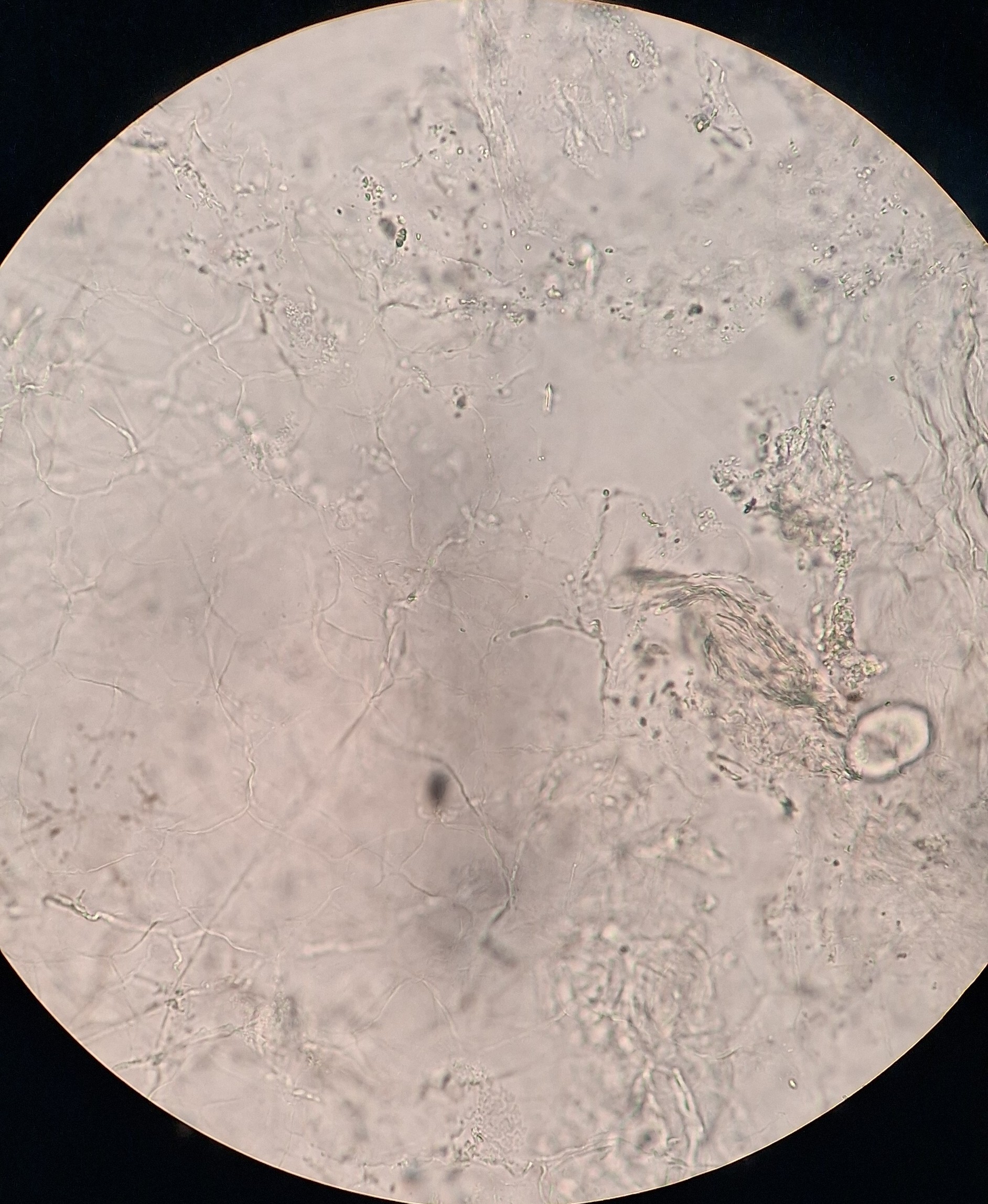 Caso clínico: Dermatitis numular