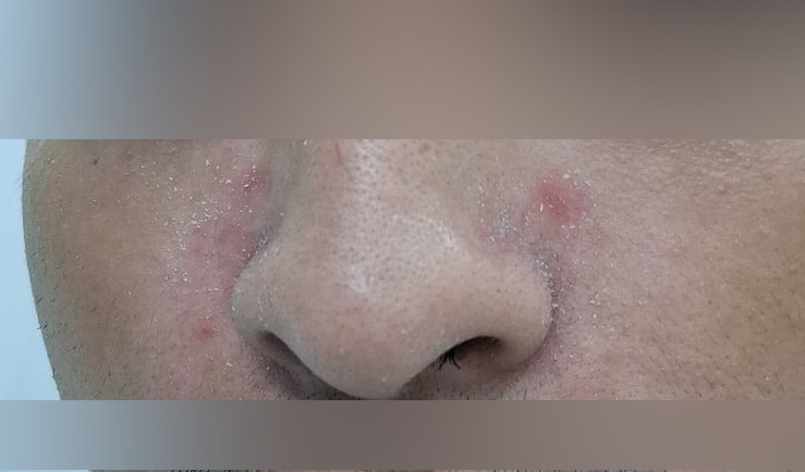 Antes - Caso clínico: Dermatitis perioral