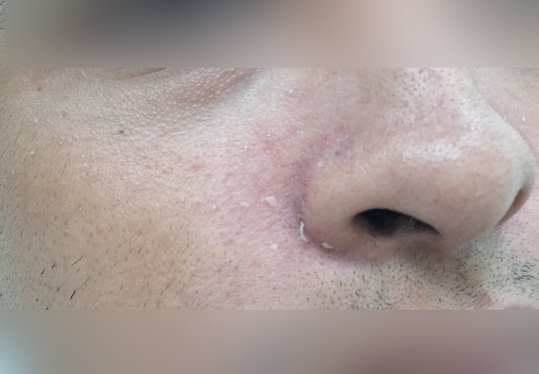 Después - Caso clínico: Dermatitis perioral
