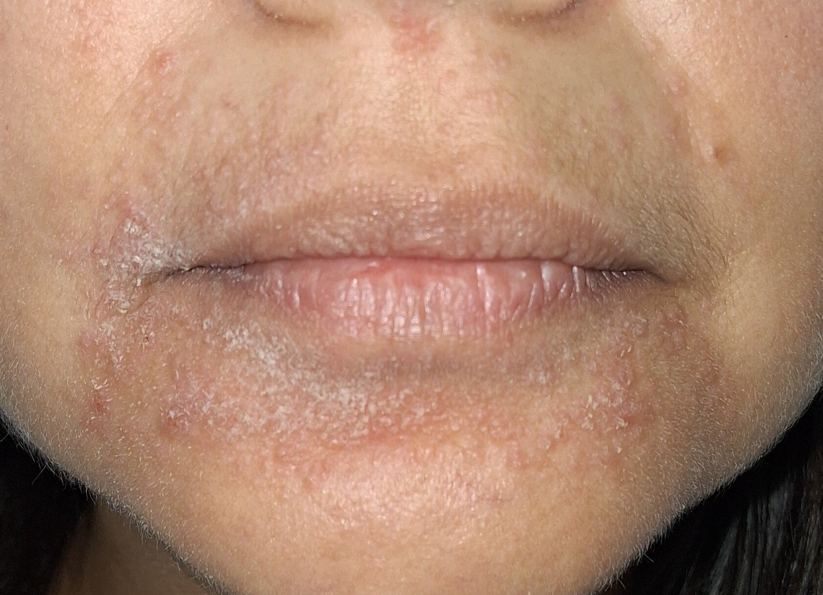 Caso clínico de Dermatitis perioral